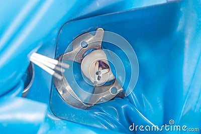 Dental caries. Filling with dental composite photopolymer material using rabbders. The concept of dental treatment in a dental cl Stock Photo