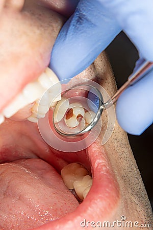 Dental caries. Filling with dental composite photopolymer material using rabbders. The concept of dental treatment in a dental cl Editorial Stock Photo