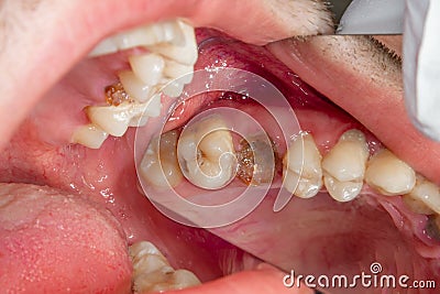 Dental caries. Filling with dental composite photopolymer material using rabbders. The concept of dental treatment in a dental cl Editorial Stock Photo