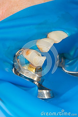 Dental caries. Filling with dental composite photopolymer material using rabbders. The concept of dental treatment in a dental Stock Photo