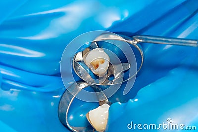 Dental caries. Filling with dental composite photopolymer material using rabbders. The concept of dental treatment in a dental Stock Photo