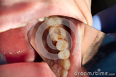 Dental caries. Filling with dental composite photopolymer material using rabbders. The concept of dental treatment in a dental Stock Photo