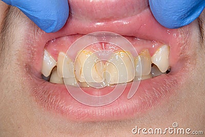 Dental caries. Filling with dental composite photopolymer material using rabbders. Concept of dental treatment in dental clinic Stock Photo