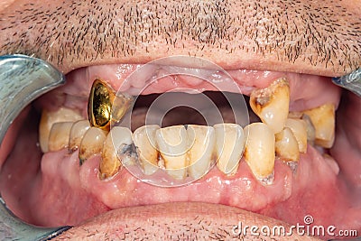 Dental caries. Filling with dental composite photopolymer material using rabbders. The concept of dental treatment in a dental Stock Photo