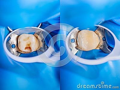 Dental caries. Filling with dental composite photopolymer material using rabbders. The concept of dental treatment in a dental Stock Photo