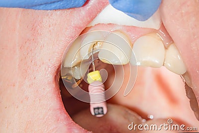 Dental caries. Filling with dental composite photopolymer material using rabbders. Concept of dental treatment in dental clinic Stock Photo