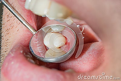 Dental caries. Filling with dental composite photopolymer material using rabbders. Concept of dental treatment in dental clinic Stock Photo