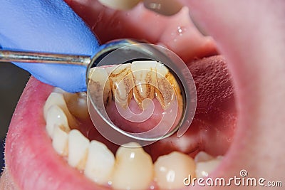 Dental caries. Filling with dental composite photopolymer material using rabbders. Concept of dental treatment in dental clinic Stock Photo