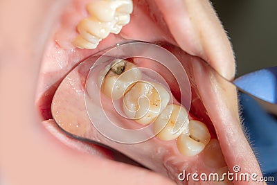 Dental caries. Filling with dental composite photopolymer material using rabbders. The concept of dental treatment in a dental Stock Photo