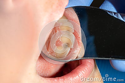 Dental caries. Filling with dental composite photopolymer material using rabbders. The concept of dental treatment in a dental Stock Photo