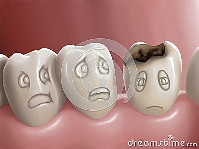 Dental caries Stock Photo