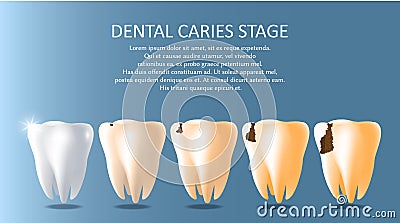 Dental caries stages vector medical poster banner template Vector Illustration
