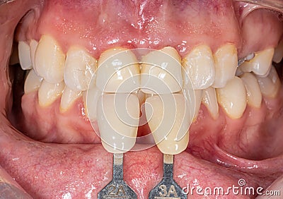 Dental color choice with shade guides Stock Photo