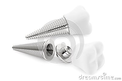 Dental concept. Tooth Implant Stock Photo