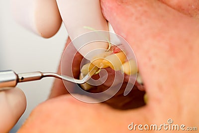 Dental cord placing in gingival sulcus Stock Photo