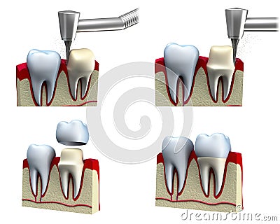 Dental crown installation process Stock Photo