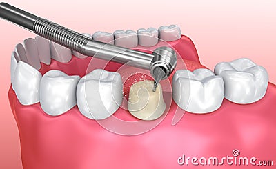 Dental crown installation process Cartoon Illustration