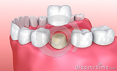 Dental crown installation process Cartoon Illustration