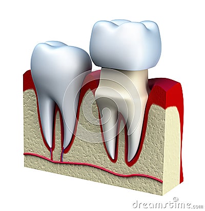 Dental crown installation process, isolated on white Stock Photo