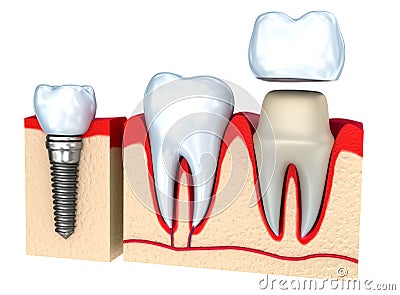 Dental crown installation process Stock Photo