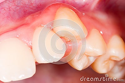 Dental displacement Stock Photo