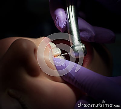 Dental drilling procedure on beautiful teeth and open mouth Stock Photo