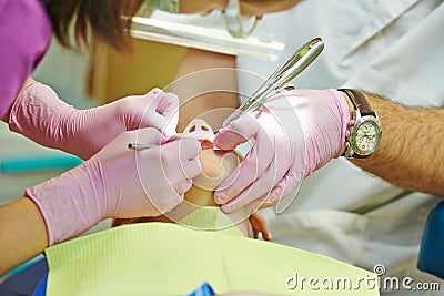 Dental filing of child tooth by ultraviolet light Stock Photo