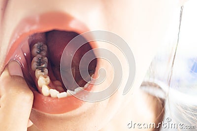 Dental fillings and dental caries Stock Photo