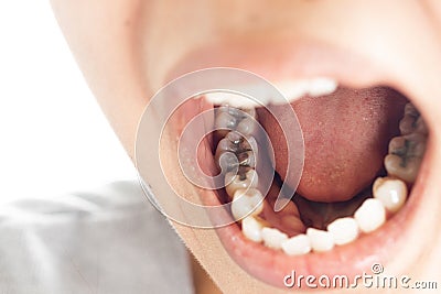 Dental fillings and dental caries Stock Photo