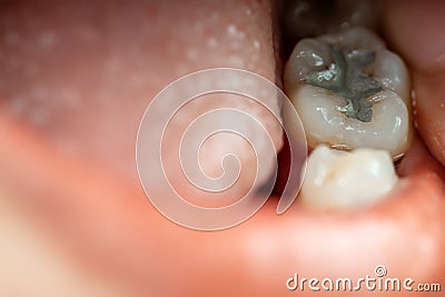 Dental fillings Stock Photo