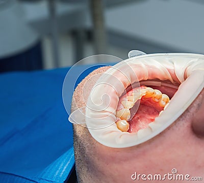 Dental fluorosis Stock Photo