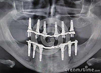 Dental guided surgery Stock Photo