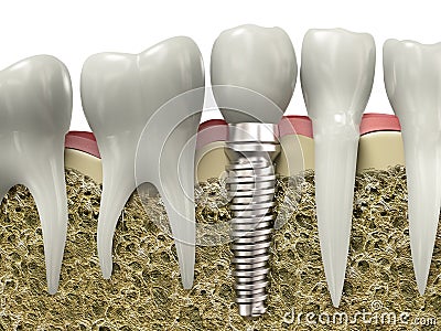 Dental implant Stock Photo