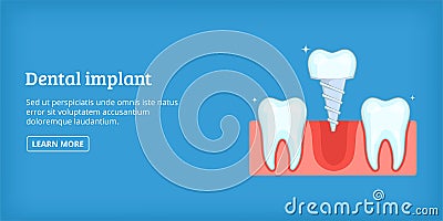 Dental implant banner horizontal, cartoon style Vector Illustration