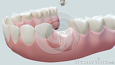 Dental Implant Bright. High quality animation 3D showing the installation process of dental implants Dental Implant Bright. High quality animation 3D showing the installation process of dental implants
