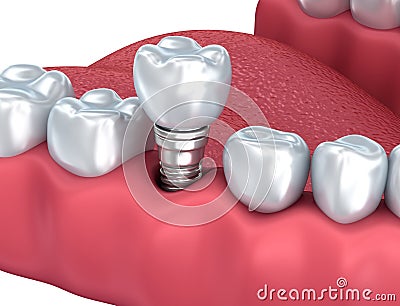 Dental implant Close-up view Stock Photo