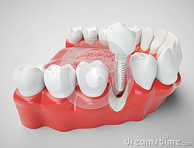 Dental implant - 3d rendering Stock Photo