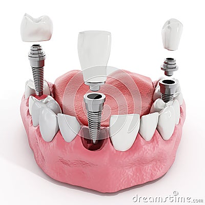 Dental implant detail Stock Photo