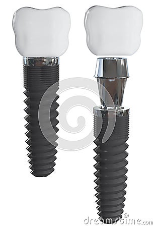 Dental implant. Elements view. Stock Photo