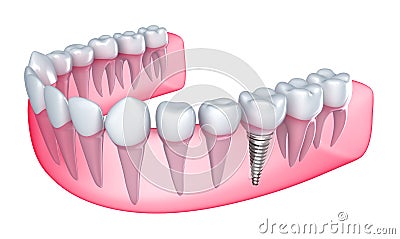 Dental implant in the gum Stock Photo