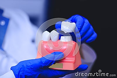 Dental implant in the hands of real doctor - model of teeth. Stock Photo