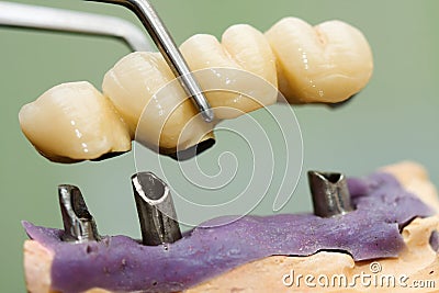 Dental implant head and bridge Stock Photo