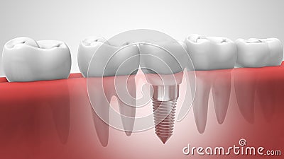 Dental implant in human denturra Stock Photo