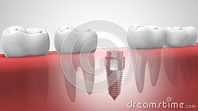 Dental implant in human denturra Stock Photo