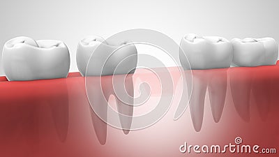 Dental implant in human denturra Stock Photo