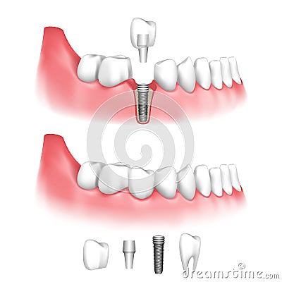 Dental implant Cartoon Illustration