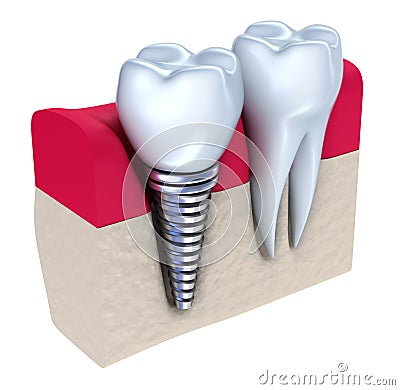 Dental implant - implanted in jaw bone Stock Photo