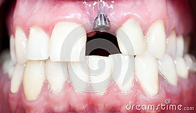 Dental implant Stock Photo