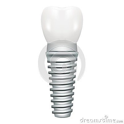 Dental Implant Model Closeup Cut Away Side View Educative Medical Poster On A White Background. Vector Vector Illustration