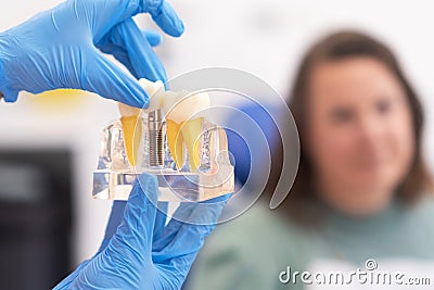 Dental implant model in modern clinic: showing teeth implantation crown, healthy teeth treatments Stock Photo